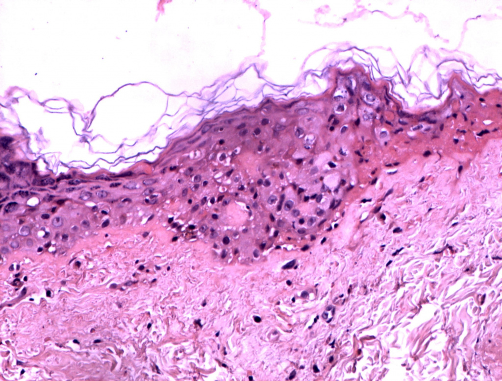 Гистология сразу после процедуры HELEO4
